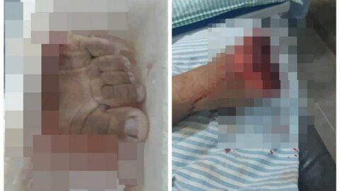 Motociclista tem pé decepado após enroscar em fio de energia, no Vale do Piancó