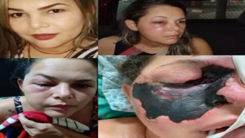 Mulher de 35 anos morre com suspeita de infecção por ‘fungo negro’, na Região Metropolitana de Patos