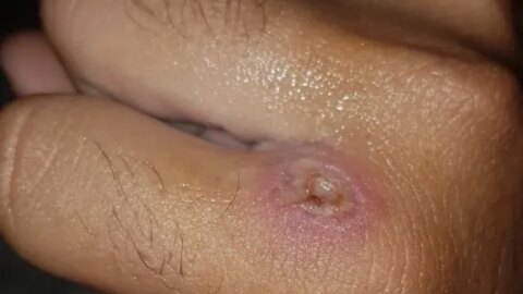 Primeiro caso de doença contagiosa e transmitida por animais de rua é registrada em Patos