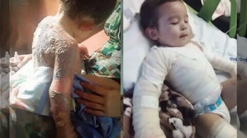Criança que se queimou com óleo quente em Conceição segue em recuperação