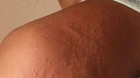 Paraíba emite alerta para profissionais de saúde notificarem casos suspeitos de coceira