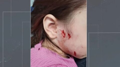 Criança de três anos é atacada por cachorro em Coremas