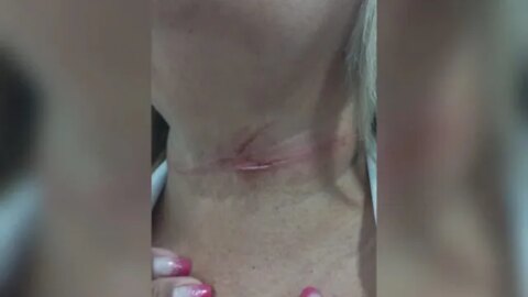 Mulher tem pescoço ferido por linha de cerol para soltar pipas, em Patos