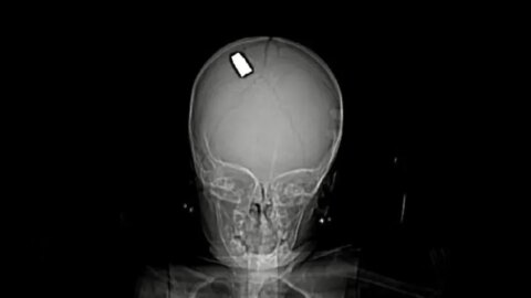 Raio-x mostra bala alojada em cérebro de bebê de 1 ano na PB: ‘nenhum sinal de sequela’, diz médico￼