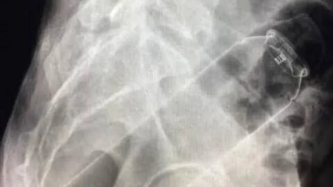 Homem com desodorante no ânus é internado em hospital da Paraíba