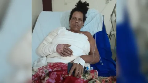 Mulher que teve mais de 70% do corpo queimado após acidente doméstico em Patos, morre dias depois de receber alta