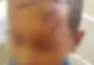 Criança de 8 anos é brutalmente agredida por vizinho com golpes de foice em Piancó-PB
