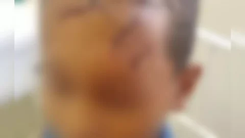 Criança de 8 anos é brutalmente agredida por vizinho com golpes de foice em Piancó-PB