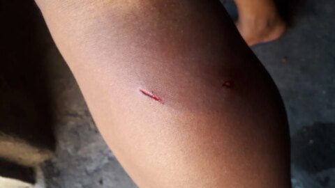 Mulher é atacada por cães em Santa Terezinha; filho pede providências