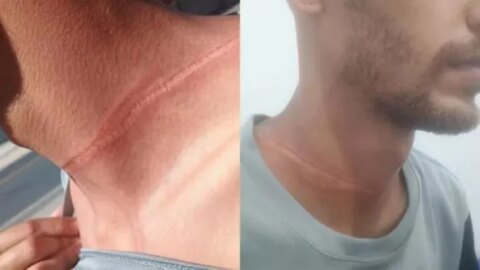 Ciclista fica ferido após se enroscar em fios soltos em Patos